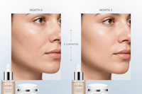 2–3 Months — Visible Reduction in Acne