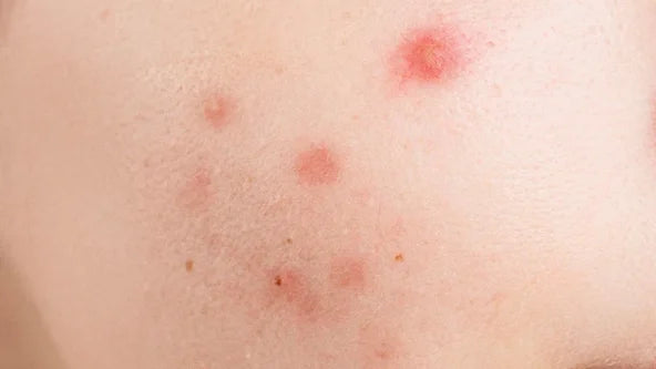 Acne
