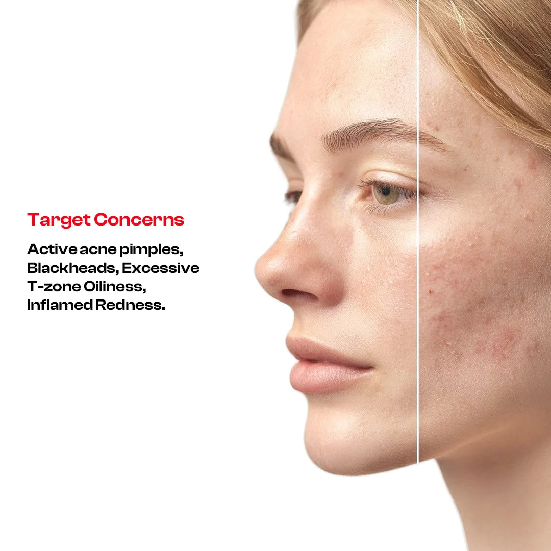 Acne Care Routine Kit | Face Wash + Anti-Acne Serum