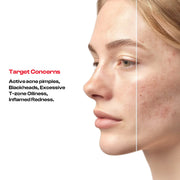 Acne Care Routine Kit | Face Wash + Anti-Acne Serum