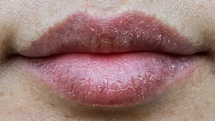 Dry Lips