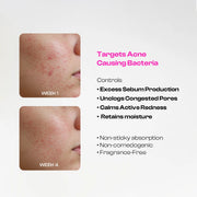 Anti Acne  Serum | Succinic Acid Acne Clarifying Serum
