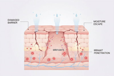 Weak Skin Barrier